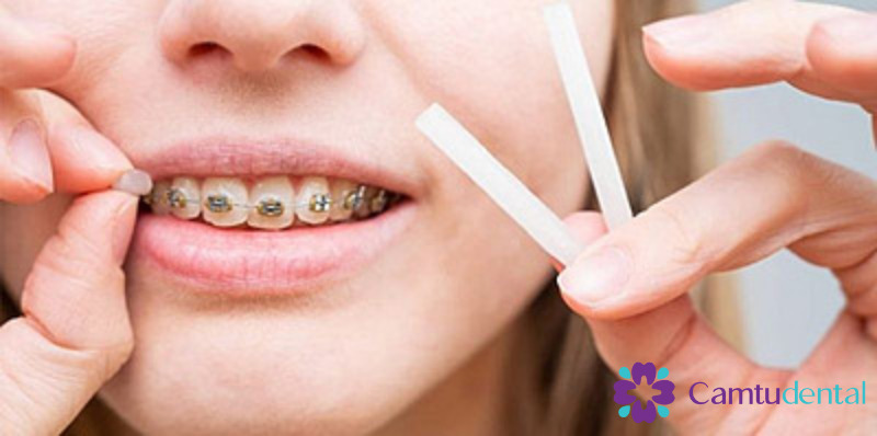 Người niềng răng bằng kim loại sử dụng sáp nha khoa để giảm bớt cảm giác khó chịu, một phương pháp phổ biến được Camtu Dental khuyên dùng cho người đeo niềng răng.