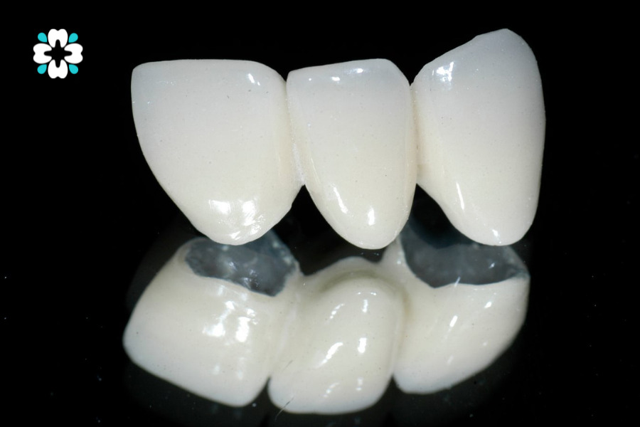 cận cảnh răng sứ kim loại titan, phiên bản tân tiến hơn của răng sứ kim loại thường