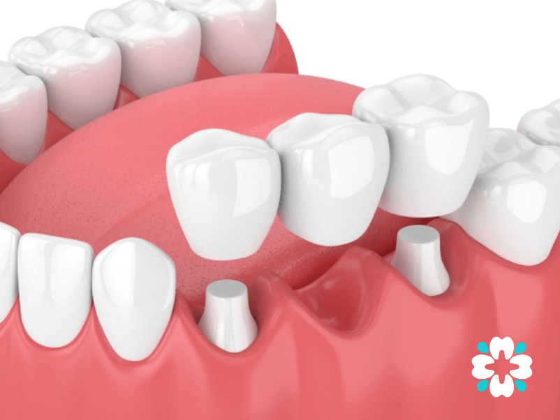 Hình minh họa 3D về cầu răng và mão răng được thiết kế để phục hồi răng, do Phòng khám Nha khoa Cẩm Tú giới thiệu.