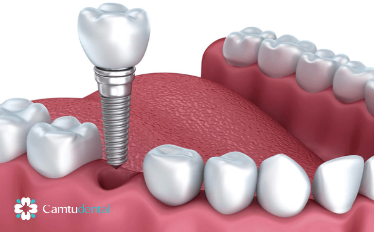 Cấy ghép Implant - phương pháp trồng răng vĩnh viễn