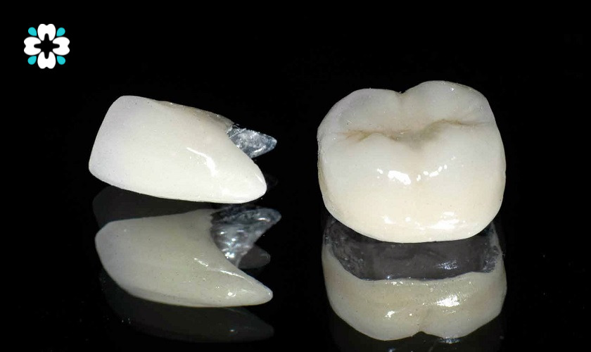 cận cảnh Răng sứ kim loại thường có màu sắc tự nhiên như răng thật