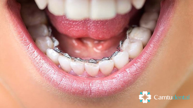 Hình ảnh hở miệng của răng hàm dưới bằng niềng răng mặt trong, phương án điều trị chỉnh nha hiện có tại Nha khoa Camtu để làm thẳng răng một cách kín đáo.