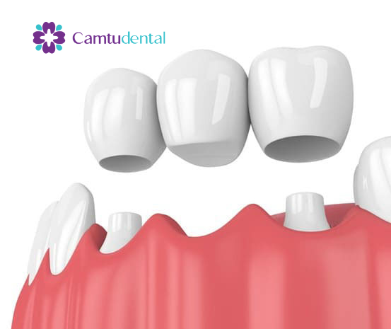 mô phỏng phương pháp cầu răng sứ truyền thống do nha khoa Cẩm Tú Quận 1 cung cấp