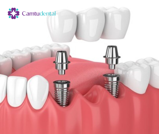 Minh họa cầu răng và vị trí cấy ghép implant trong xương hàm của Nha khoa Camtu, nêu bật các thành phần trước khi gắn mão răng cuối cùng.