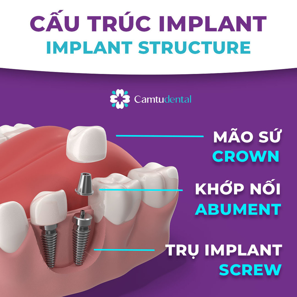 hình ảnh mô tả cấu trúc của trụ Implant châu Âu bao gồm mão sứ, khớp nối abuttment và trụ implant