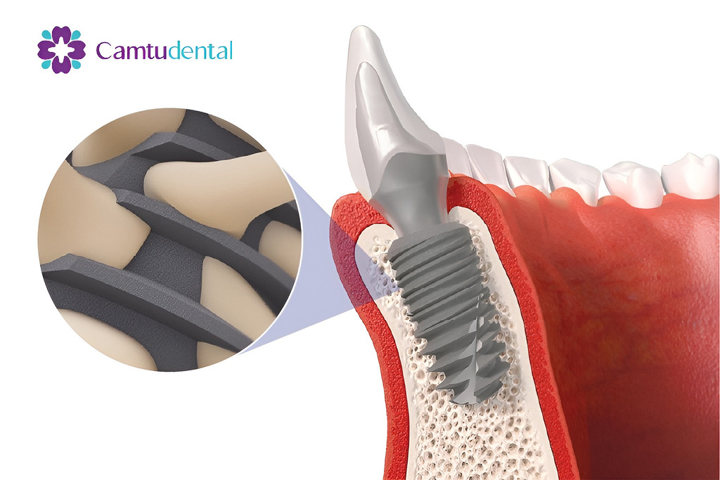 Kết xuất 3D chi tiết của một trụ implant trong xương hàm, làm nổi bật cấu trúc và sự hỗ trợ mà nó mang lại