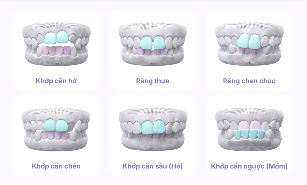 Mô phỏng 6 trường hợp nên niềng răng mắc cài sứ như khớp cắn hở, răng thưa, răng chen chúc, khớp cắn chéo, hô, móm