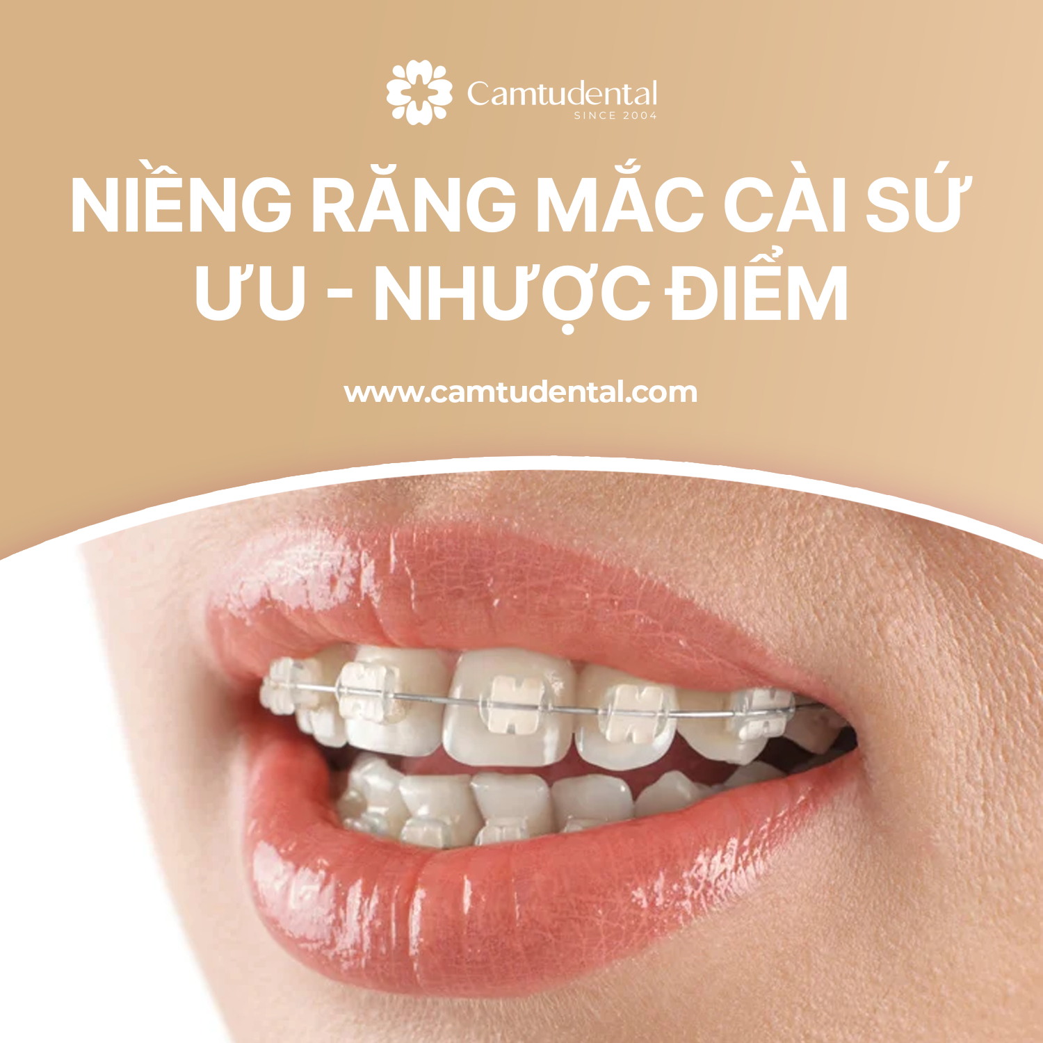 Niềng răng mắc cài sứ tại Nha khoa Cẩm Tú Quận 1