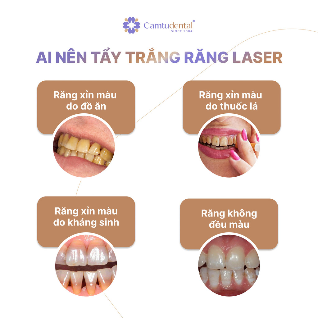 image 2 1 - Tẩy Trắng Răng Bằng Laser: Quy Trình Tẩy Trắng Răng Và 5 Điều Bạn Cần Biết - Hệ thống Nha khoa Cẩm Tú