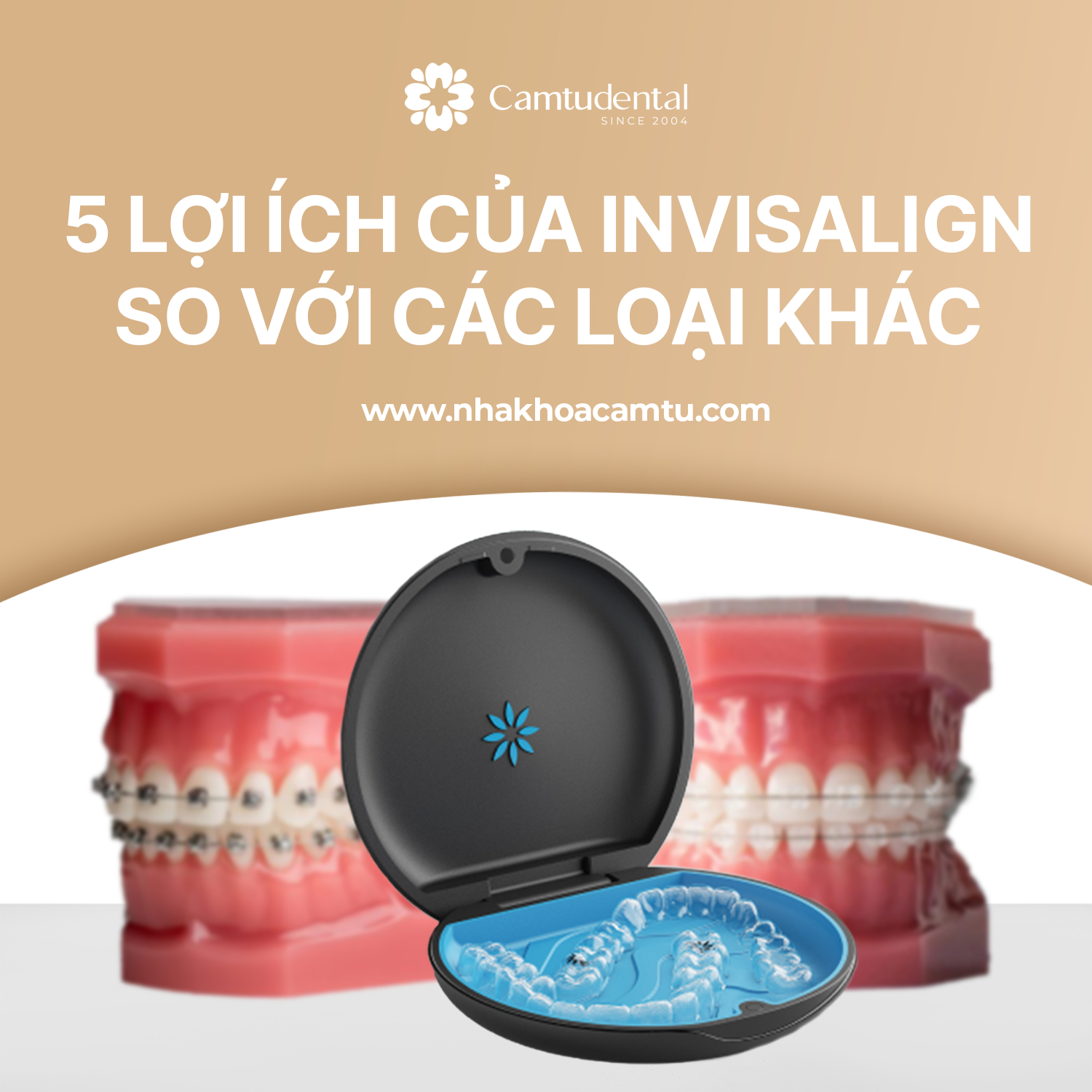 Ảnh mô tả lợi ích của Invisalign so với niềng răng mắc cài kim loại và mắc cài sứ