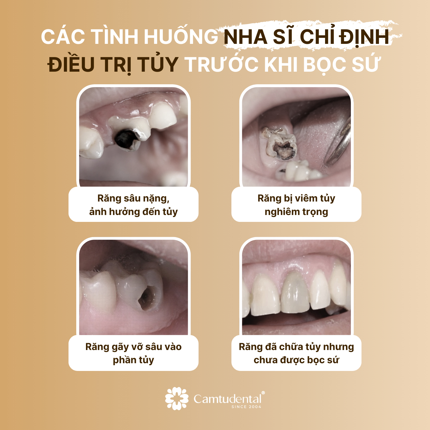 Điều Trị Tủy: Đối Tượng, Quy Trình, Chi Phí Điều Trị Tủy Răng? 3 5 trường hợp nha sĩ chỉ định điều trị tủy