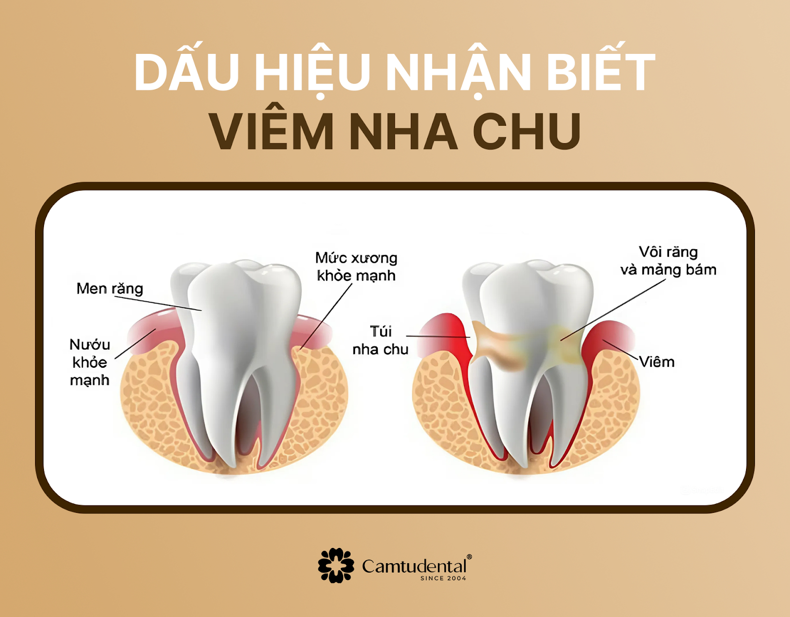 Viêm Nha Chu: Nguyên Nhân, Dấu Hiệu và Cách Điều Trị Hiệu Quả 2 phân biệt giữa răng khỏe mạnh và răng bị viêm nha chu
