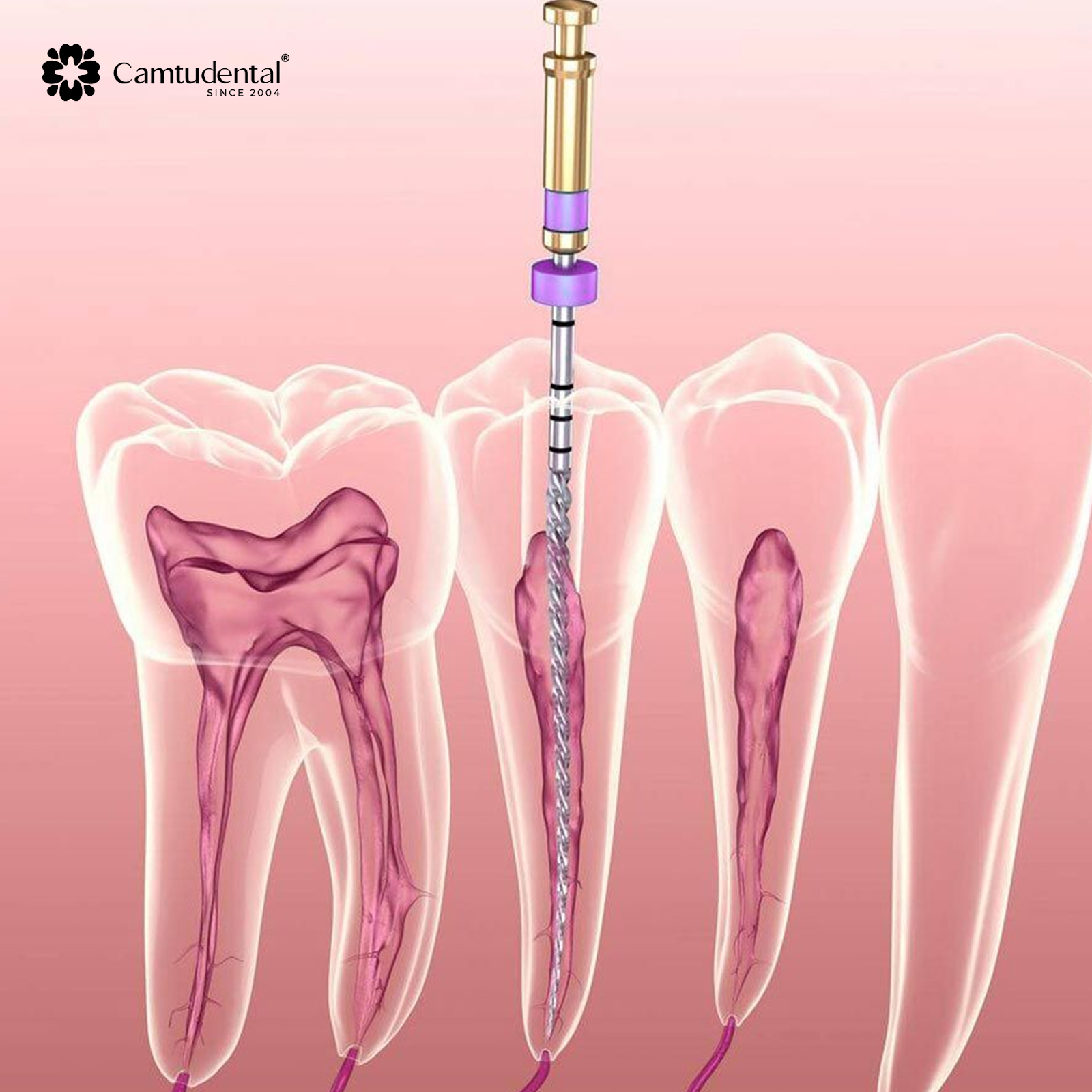 Điều Trị Tủy: Đối Tượng, Quy Trình, Chi Phí Điều Trị Tủy Răng? 6 minh họa điều trị tủy