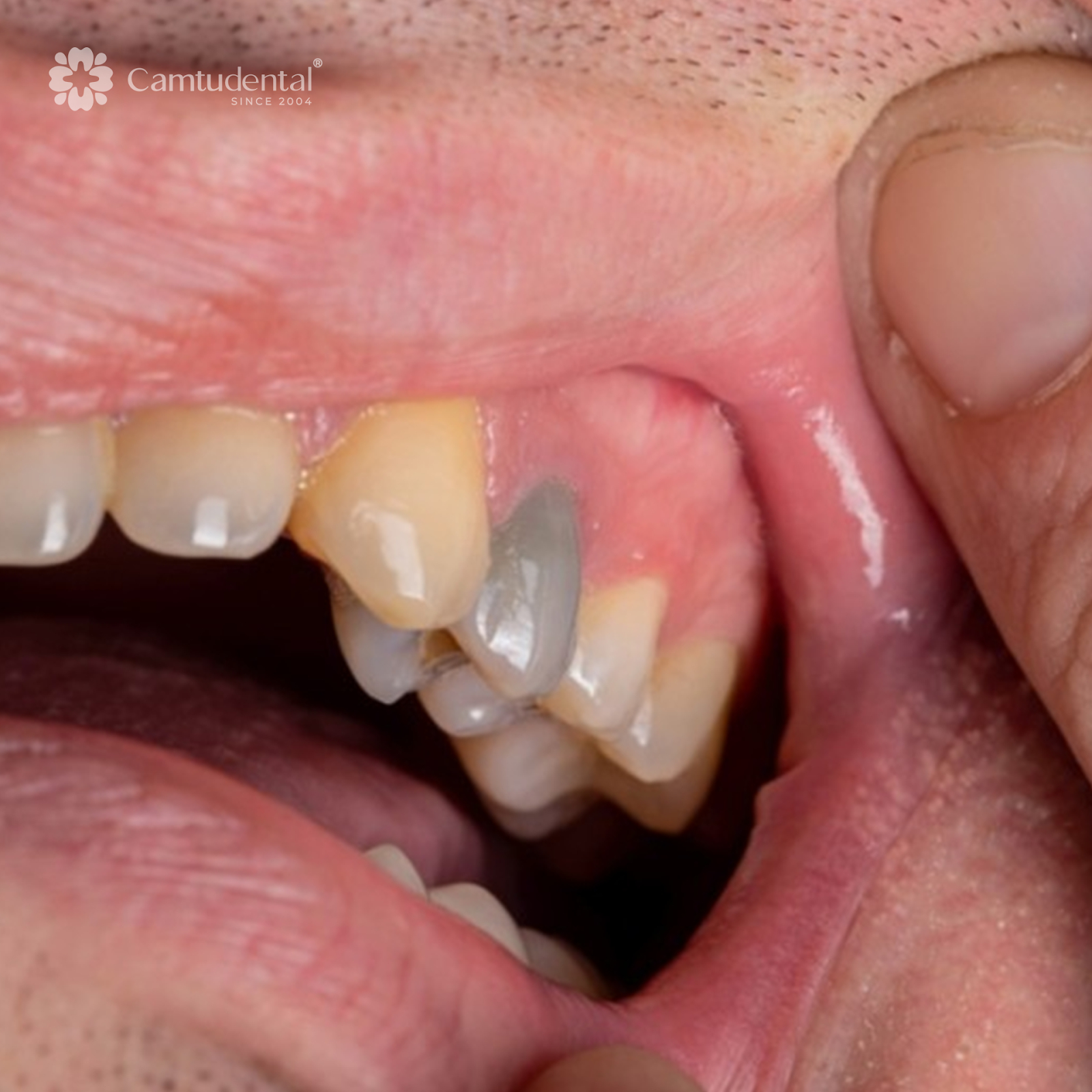 Điều Trị Tủy: Đối Tượng, Quy Trình, Chi Phí Điều Trị Tủy Răng? 2 AD 4nXeC9oUOBNk65uUCZr9WKC6gwT 9F8QpdTDOwVXP8lBxV52odVM lR83jLRoo2ePpfnl7P2sR6r NUMi772wd0etGCm1HScbk CSh9PT3py5Bcl 2z 546u0hUWiTEhDInhU93vsow - Điều Trị Tủy: Đối Tượng, Quy Trình, Chi Phí Điều Trị Tủy Răng? - Hệ thống Nha khoa Cẩm Tú