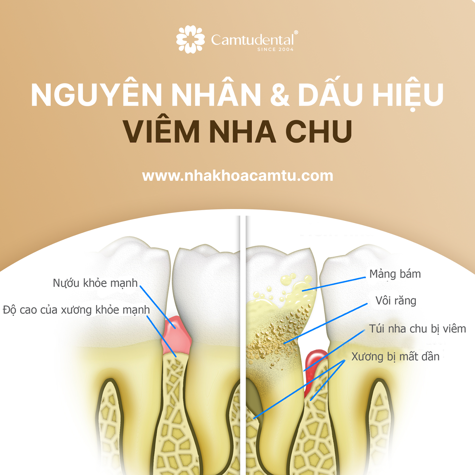 Viêm Nha Chu: Nguyên Nhân, Dấu Hiệu và Cách Điều Trị Hiệu Quả 1 nguyên nhân và dấu hiệu bệnh viêm nha chu