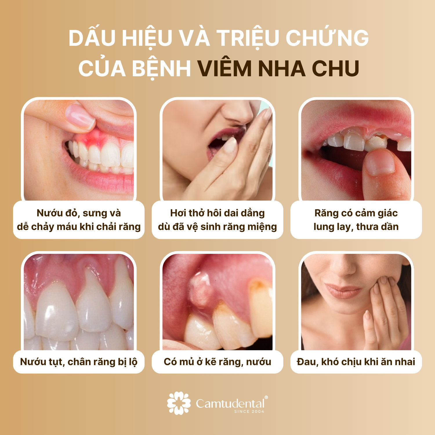 Viêm Nha Chu: Nguyên Nhân, Dấu Hiệu và Cách Điều Trị Hiệu Quả 3 6 dấu hiệu viêm nha chu
