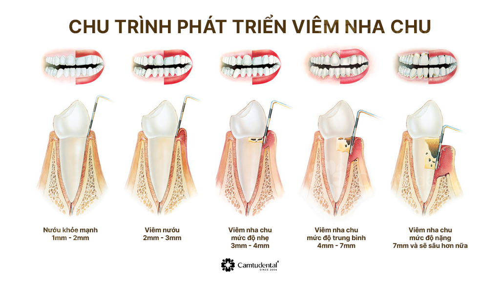 Viêm Nha Chu: Nguyên Nhân, Dấu Hiệu và Cách Điều Trị Hiệu Quả 4 AD 4nXfX7k2AwkxJEU cZOEz pmqBmCa6yQaizCQPDaL5pJG4aU6VLD90TYaLgNG21bjxc6Wwov qfn6loVC wLGX8DAE6y6TEN3M7JfvH0DdfCblwOsPVkiMmS1id2sXQ03zzrjVCa w - Viêm Nha Chu: Nguyên Nhân, Dấu Hiệu và Cách Điều Trị Hiệu Quả - Hệ thống Nha khoa Cẩm Tú