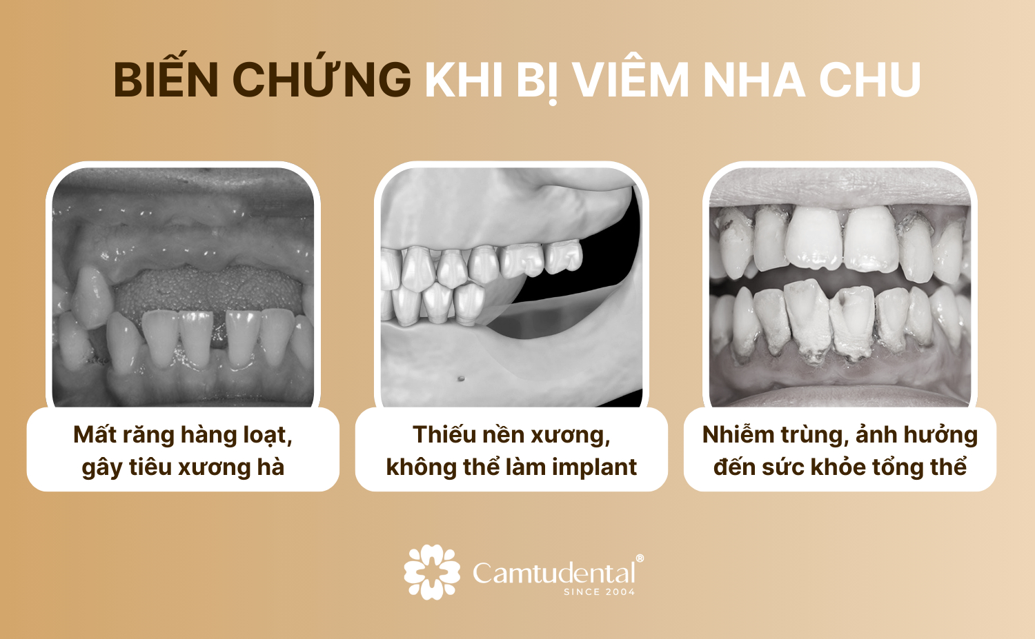 Viêm Nha Chu: Nguyên Nhân, Dấu Hiệu và Cách Điều Trị Hiệu Quả 5 3 biến chứng có thể xảy ra nếu không điều trị viêm nha chu