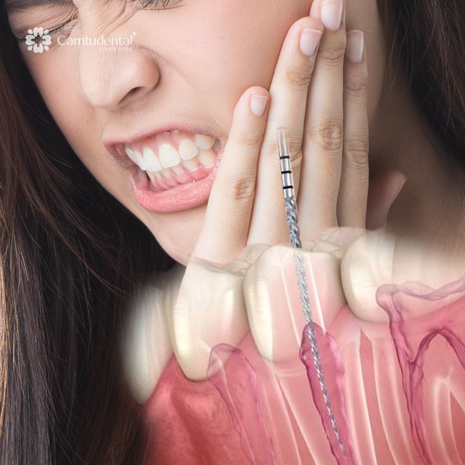 Điều Trị Tủy: Đối Tượng, Quy Trình, Chi Phí Điều Trị Tủy Răng? 7 AD 4nXfjWPmsD71Z8AOW1iCyO0gvrJIJtHA1bvgOy0q2P6WmaMd ik4tD7f3DOLnzfzamH8HPikf6QYuCNWJmuf4Pdp - Điều Trị Tủy: Đối Tượng, Quy Trình, Chi Phí Điều Trị Tủy Răng? - Hệ thống Nha khoa Cẩm Tú