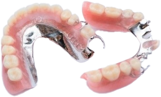 hàm khung kim loại