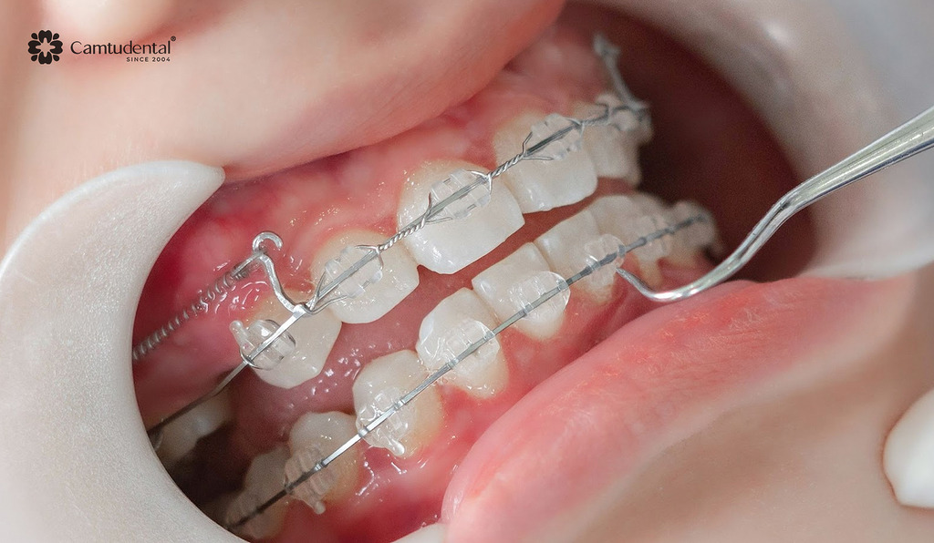 Niềng răng trẻ em: Bao lâu thì hoàn thành và chi phí ra sao? 6 niềng răng mắc cài sứ