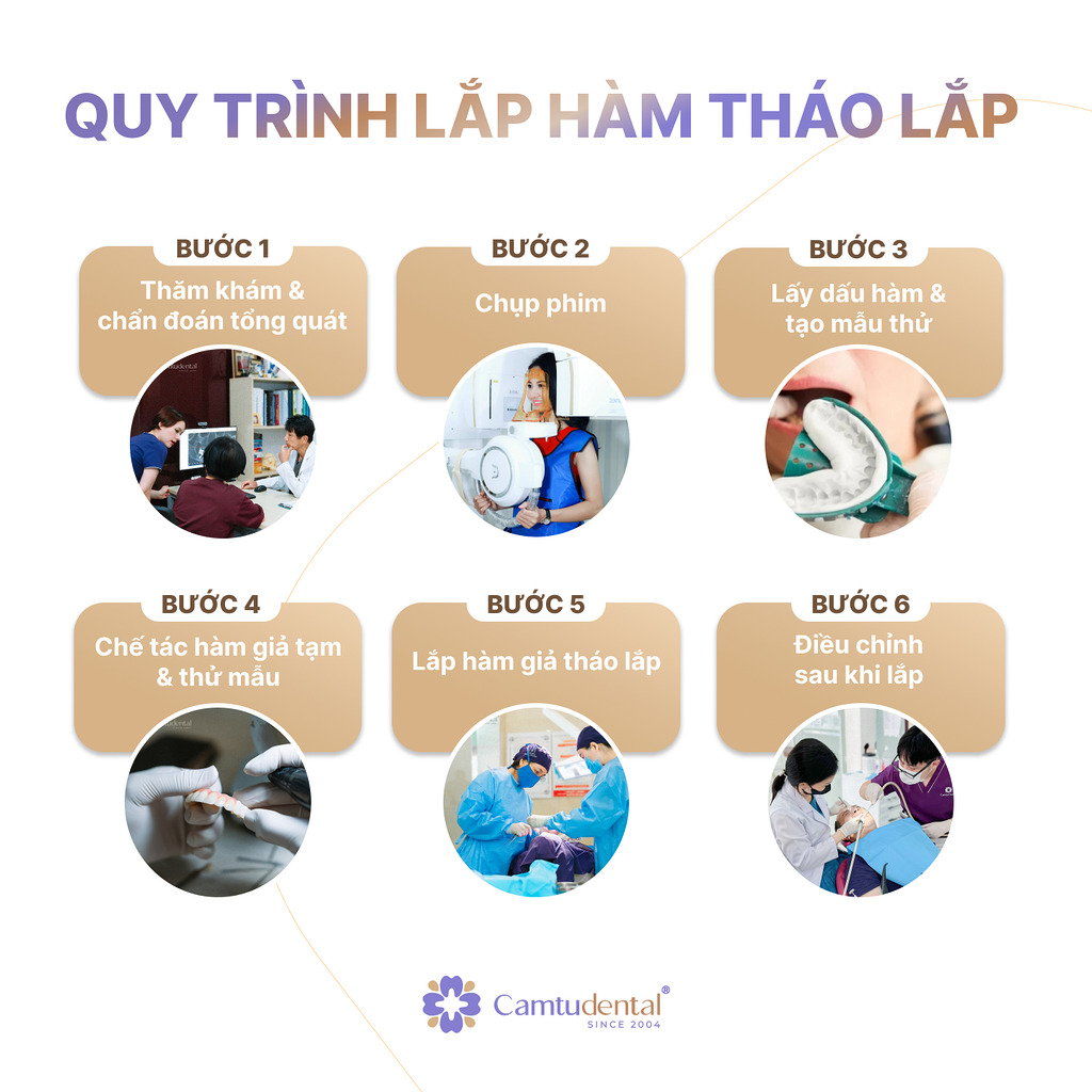 6 bước quy trình làm hàm giả tháo lắp