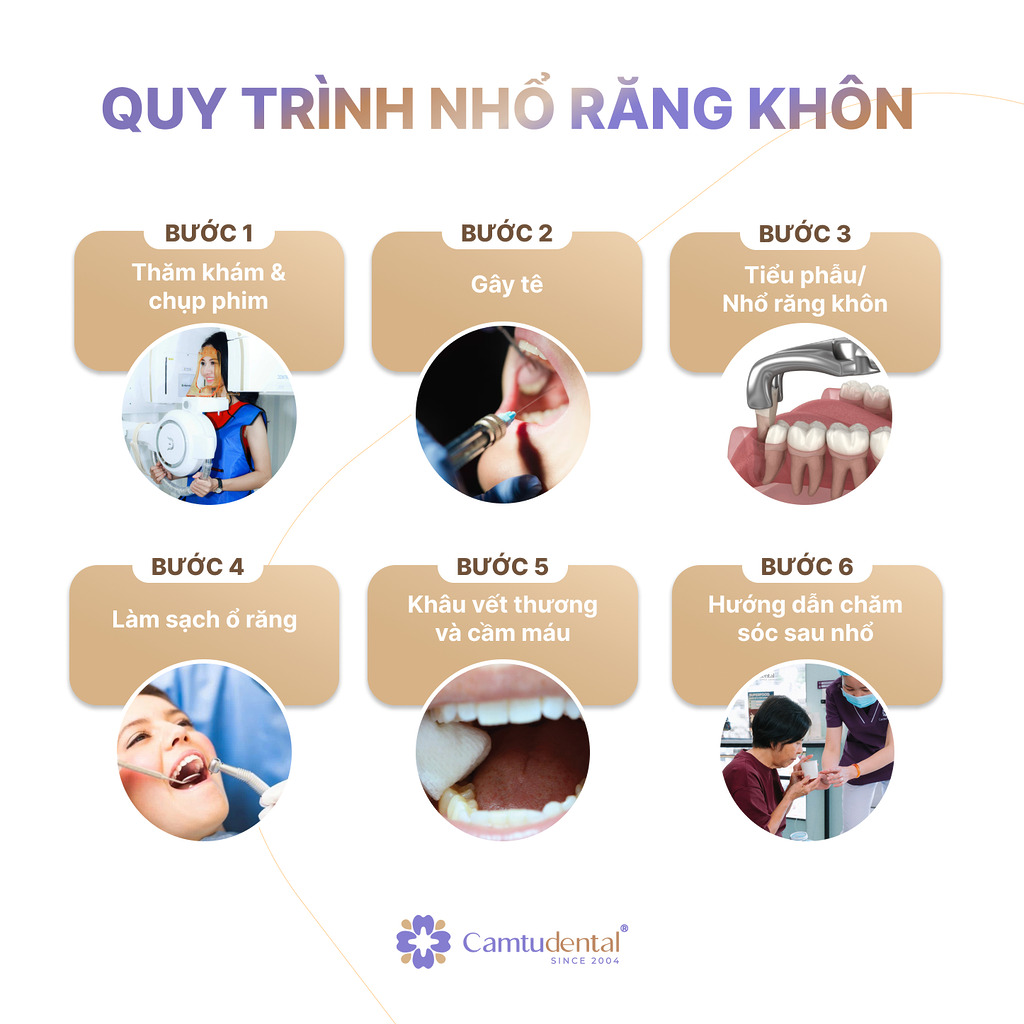 Nhổ Răng Khôn: Tất Tần Tật Những Điều Bạn Cần Biết 3 6 bước quy trình nhổ răng khôn tại nha khoa Cẩm Tú quận 1