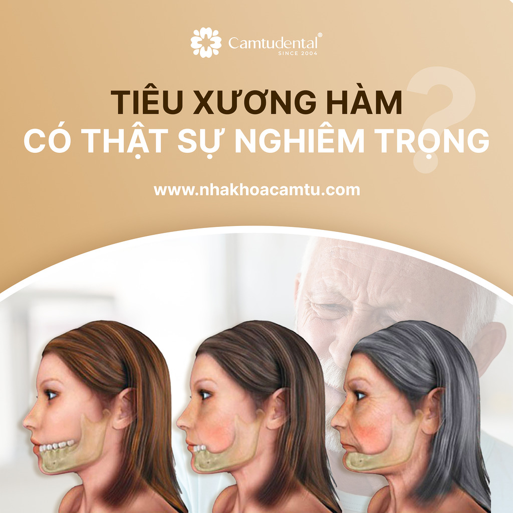 tiêu xương hàm có nghiêm trọng không