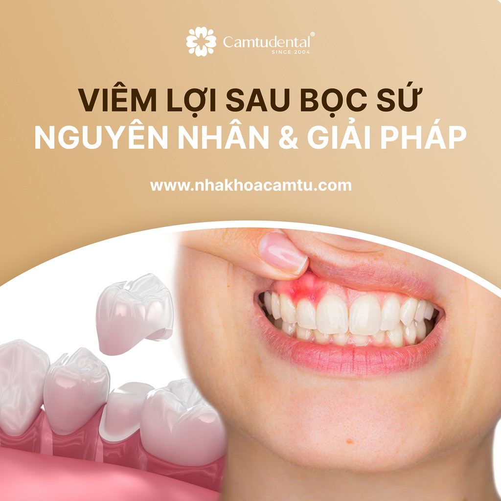 Viêm lợi sau khi bọc sứ