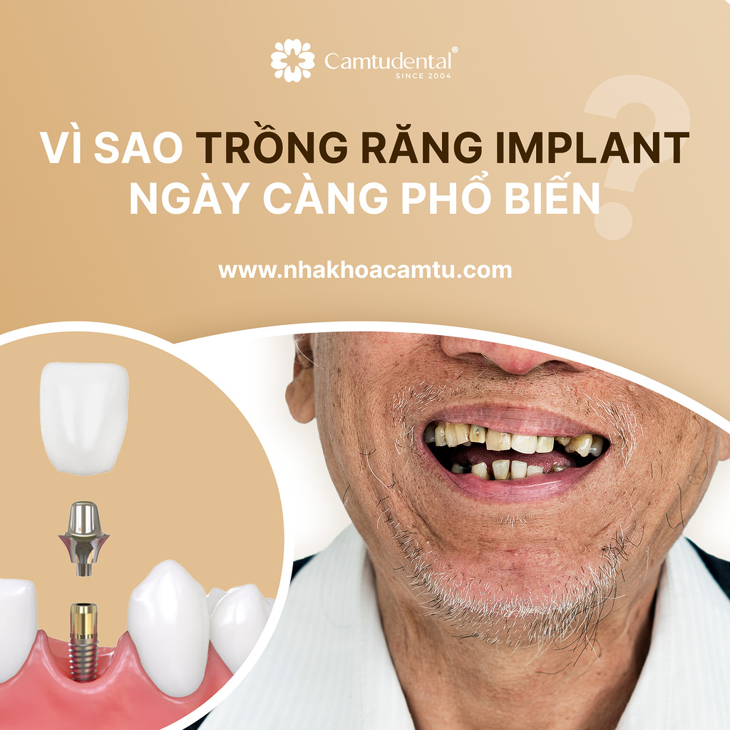 Vì sao trồng răng implant ngày càng phổ biến