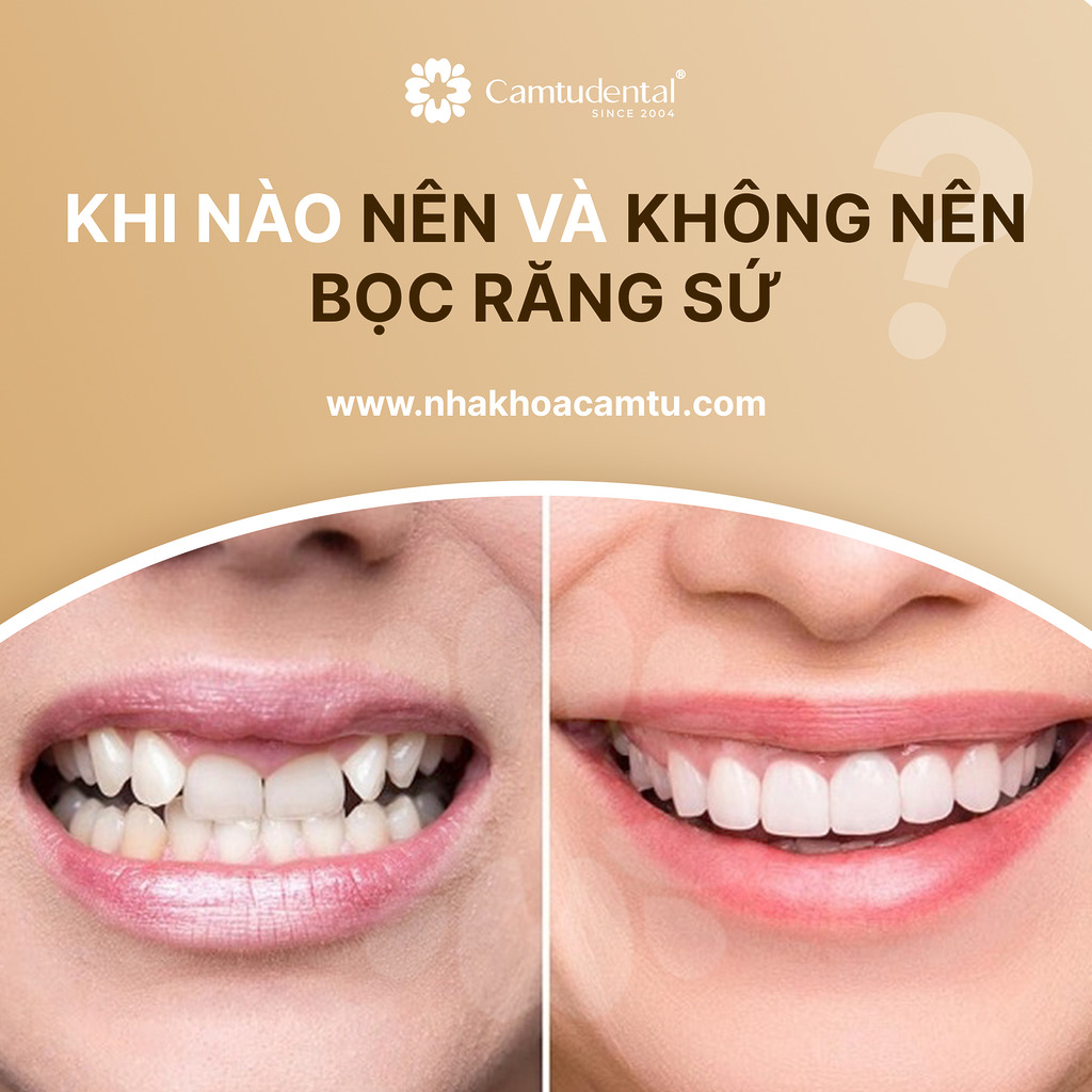 Có Nên Bọc Răng Sứ Không? Khi Nào Nên và Không Nên Lựa Chọn 1 W2 Blog 1 Cover - Có Nên Bọc Răng Sứ Không? Khi Nào Nên và Không Nên Lựa Chọn - Hệ thống Nha khoa Cẩm Tú