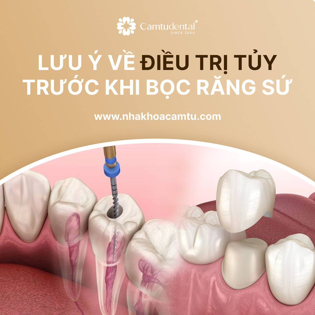 lưu ý điều trị tủy trước khi bọc răng sứ