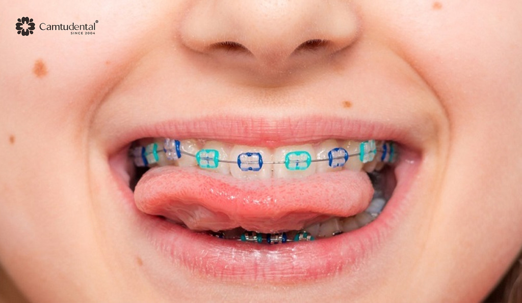 Niềng răng trẻ em: Bao lâu thì hoàn thành và chi phí ra sao? 2 bé gái đang đeo niềng răng mắc cài kim loại nhiều màu