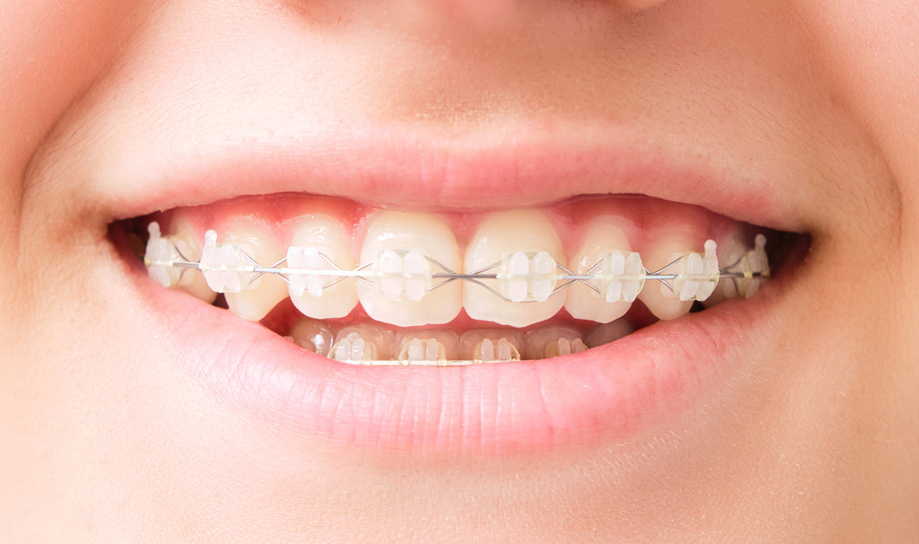 closeup of white teenage girl's mouth smiling with invisible white dental aligner
