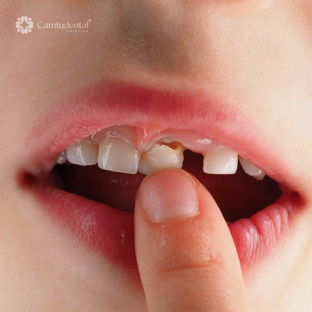 Những điều cần biết trước khi nhổ răng sữa cho trẻ 3 răng cửa trẻ em bị lung lay