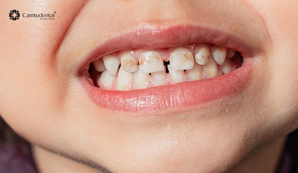 Khi nào cần trám răng sữa cho trẻ? 4 răng sữa bị mòn