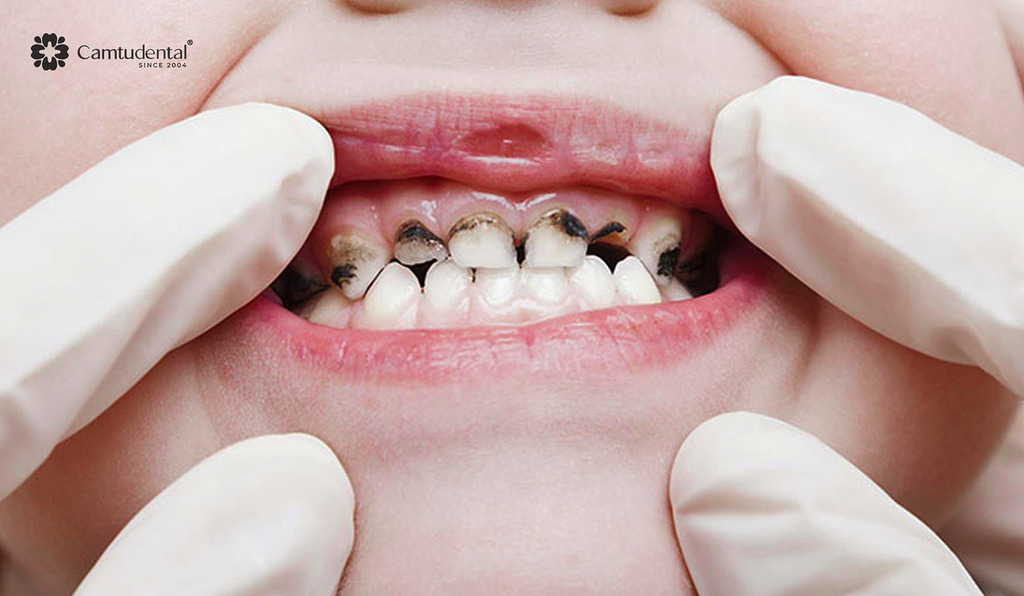 Khi nào cần trám răng sữa cho trẻ? 2 răng sữa bị sâu
