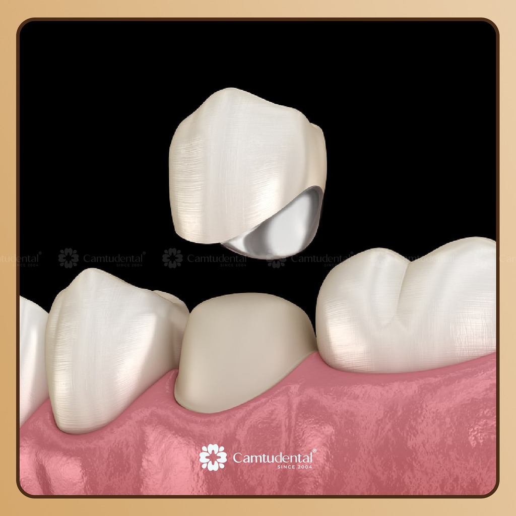 Thay mới mão sứ