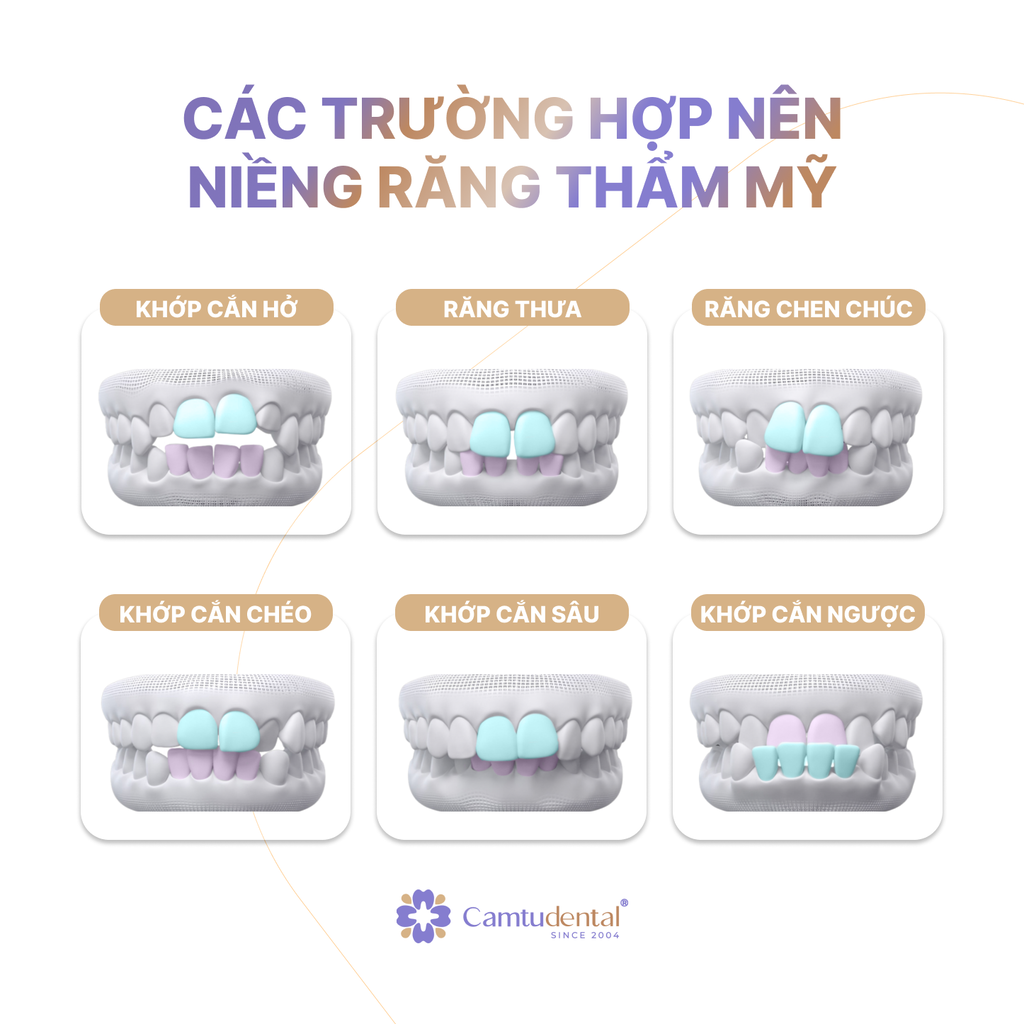 Chỉ Niềng Răng Cửa Có Được Không? Điều Bạn Cần Biết Trước Khi Quyết Định 2 các trường hợp chỉ nên niềng răng cửa