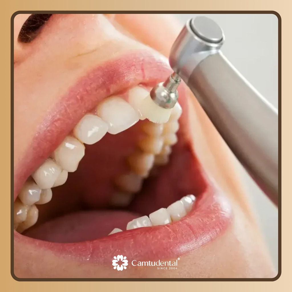 đánh bóng răng sứ định kỳ