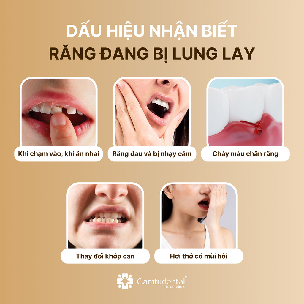 5 dấu hiệu nhận biết răng đang bị lung lay
