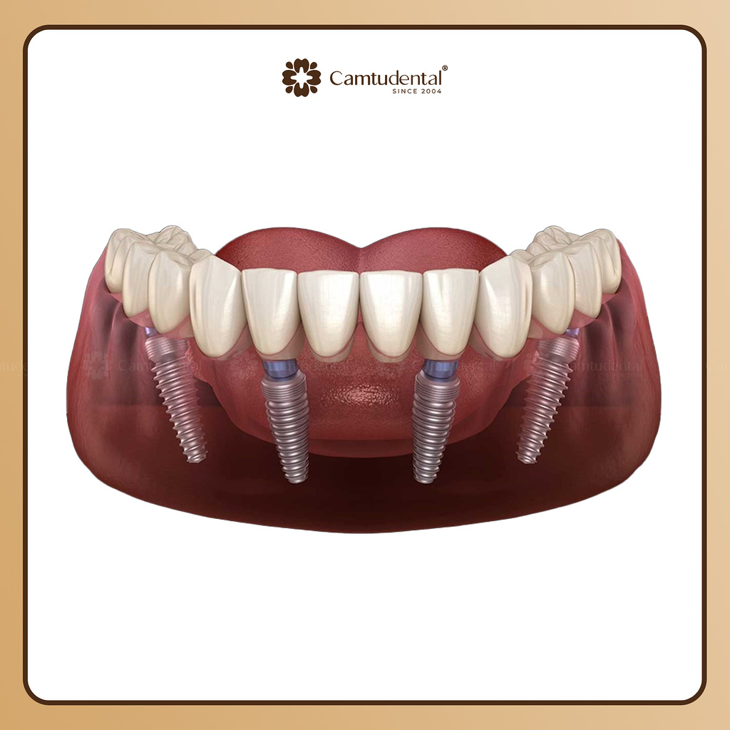Trồng răng Implant All On 4 