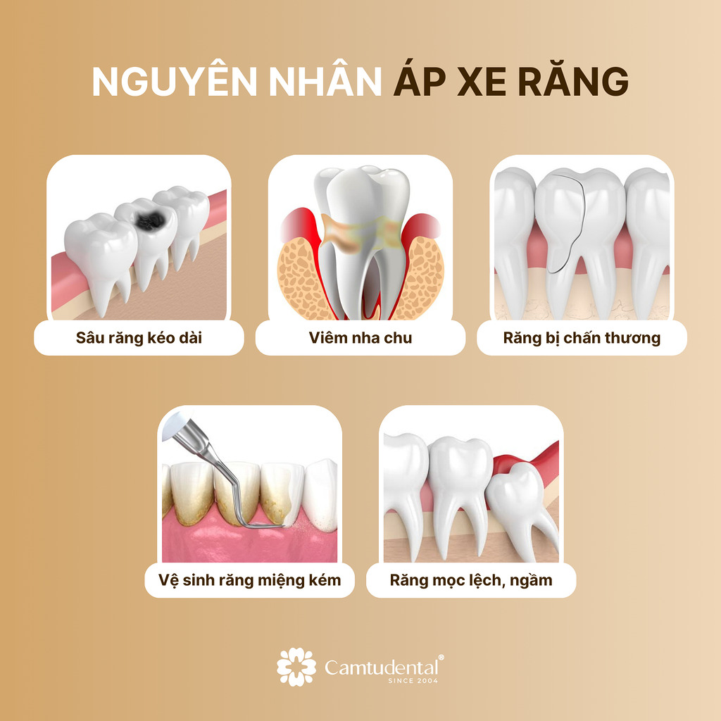 5 nguyên nhân gây ra áp xe răng