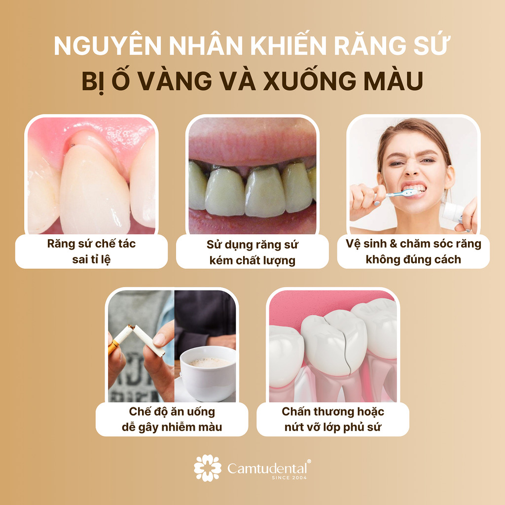 5 nguyên nhân khiến răng sứ bị ố vàng và nhiễm màu