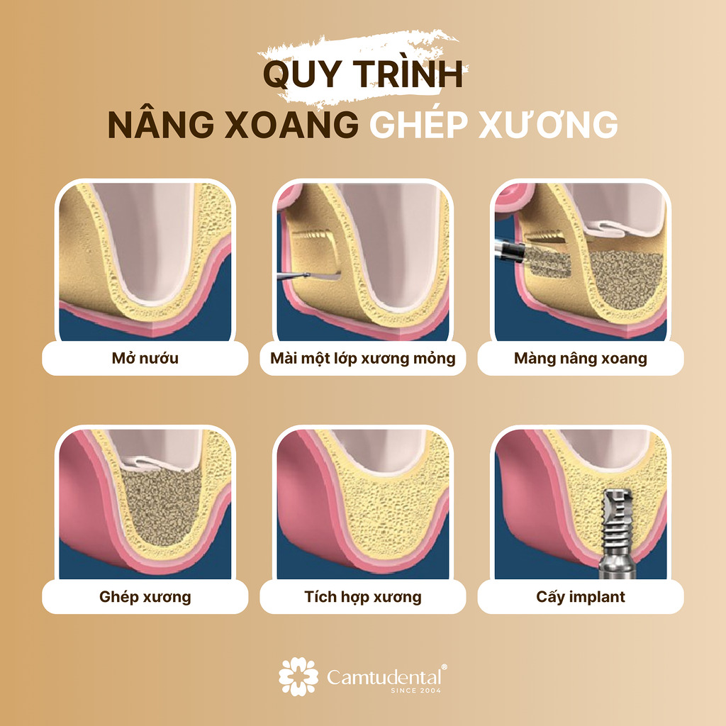 Quy trình nâng xoang ghép xương trong cấy ghép implant