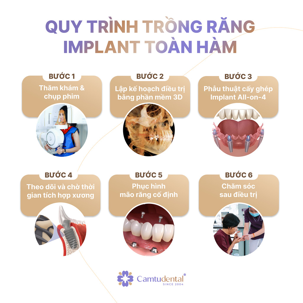 Quy trình cấy ghép Implant All on 4 tại Nha khoa Cẩm Tú
