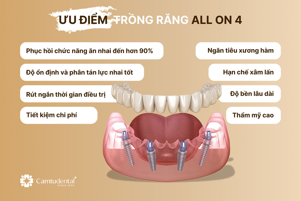 Ưu điểm của phương pháp trồng răng All On 4