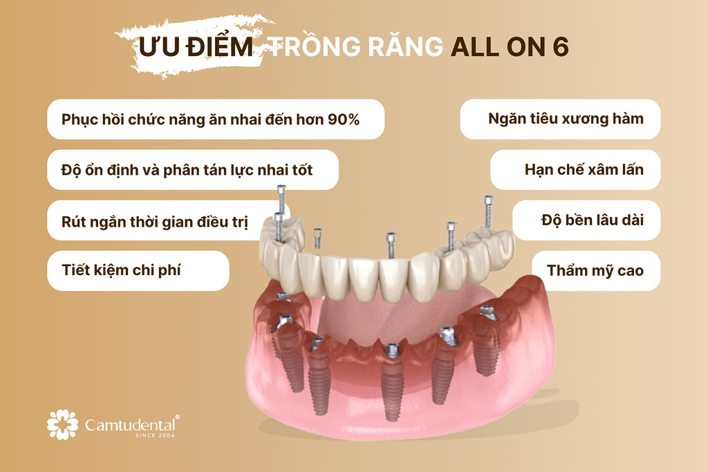 Ưu điểm của phương pháp trồng răng All on 6