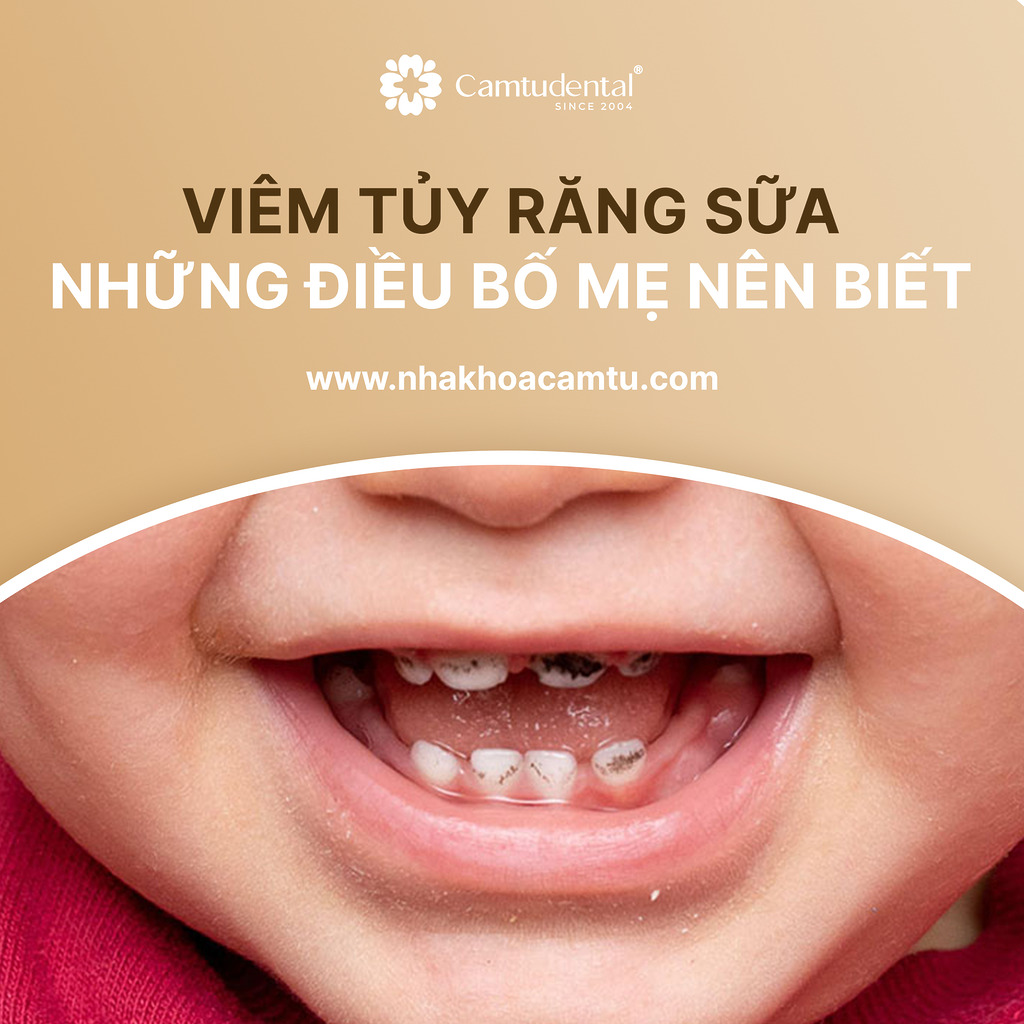 viêm tủy răng sữa