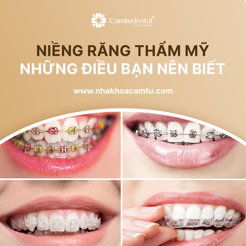 Niềng Răng Thẩm Mỹ: Tất Tần Tật Những Điều Cần Biết Về Niềng Răng 5 4 loại niềng răng thẩm mỹ